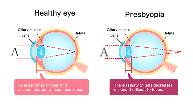 A comparison diagram showing a healthy eye and an eye with presbyopia. The healthy eye's lens thickens to focus on a near object, while the presbyopic eye's lens has decreased elasticity, making it difficult to focus. The healthy eye focuses light directly on the retina, while the presbyopic eye does not.