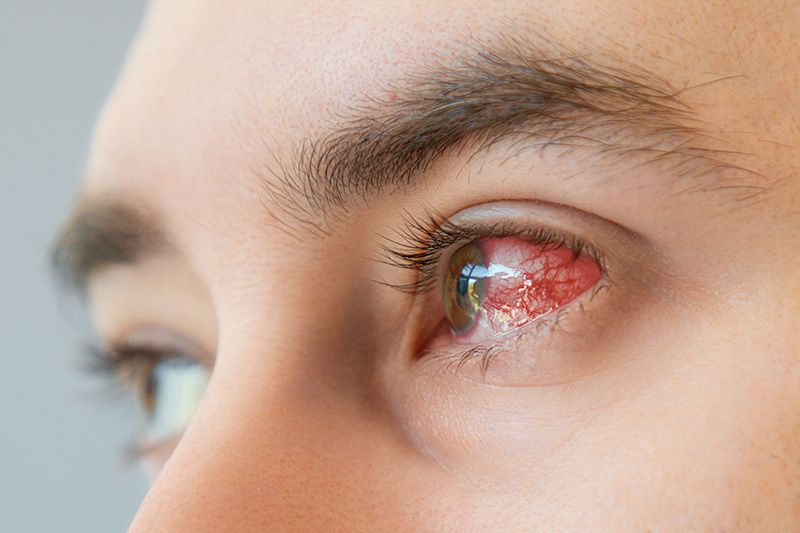 Close up of eye with bloodshot and redness with vessels.